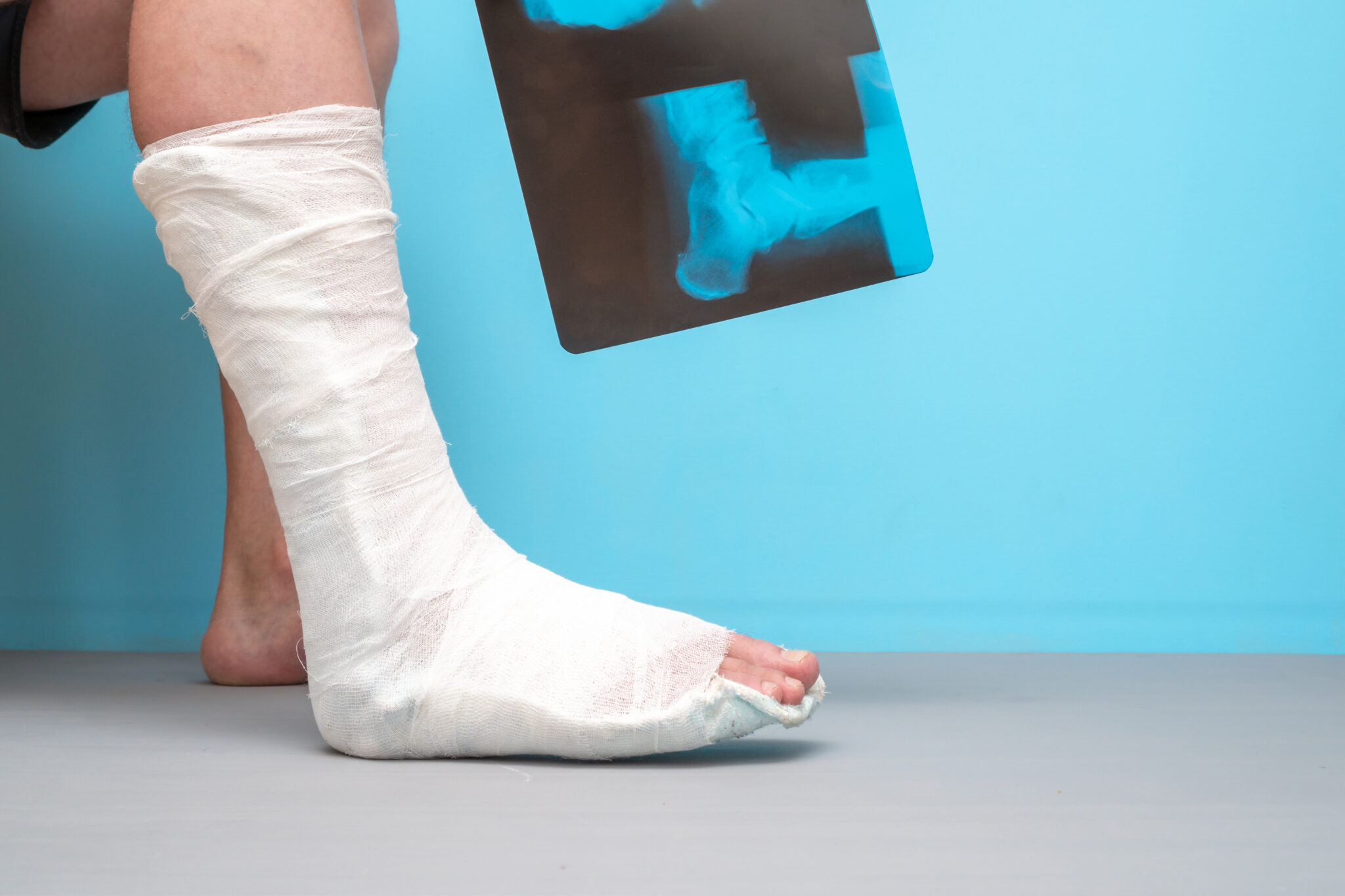 Fracture fixation using plates, rods, or screws when needed